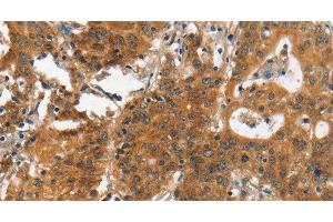 Immunohistochemistry of paraffin-embedded Human gastic cancer using ITGA2 Polyclonal Antibody at dilution of 1:30