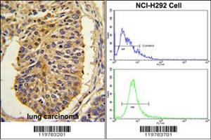 (LEFT)Formalin-fixed and paraffin-embedded human lung carcinoma with CER1 Antibody (N-term), which was peroxidase-conjugated to the secondary antibody, followed by DAB staining. (CER1 抗体  (N-Term))
