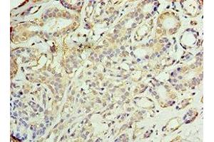 Immunohistochemistry of paraffin-embedded human breast cancer using ABIN7142902 at dilution of 1:100 (AKAP1 抗体  (AA 413-662))
