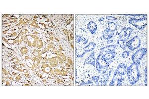 Immunohistochemistry analysis of paraffin-embedded human colon carcinoma tissue, using MRPS7 antibody. (FUT3 抗体  (Internal Region))