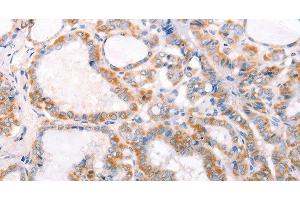 Immunohistochemistry of paraffin-embedded Human thyroid cancer using TRAF5 Polyclonal Antibody at dilution of 1:30 (TRAF5 抗体)