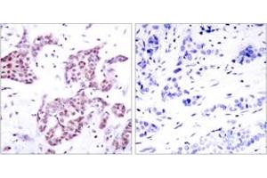 Immunohistochemistry analysis of paraffin-embedded human breast carcinoma, using STAT6 (Phospho-Tyr641) Antibody. (STAT6 抗体  (pTyr641))