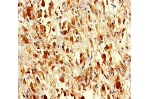 Immunohistochemistry of paraffin-embedded human melanoma using ABIN7168949 at dilution of 1:100 (Seryl-tRNA Synthetase (SARS) (AA 2-233) 抗体)