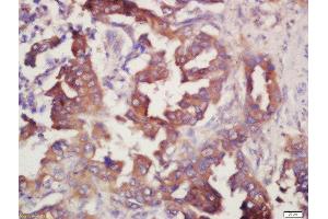 Formalin-fixed and paraffin embedded human lung carcinoma labeled with Rabbit Anti-Prostaglandin E Receptor EP4 Polyclonal Antibody, Unconjugated (ABIN1387963) at 1:200 followed by conjugation to the secondary antibody and DAB staining (PTGER4 抗体  (AA 151-250))