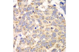 Immunohistochemistry of paraffin-embedded human esophageal cancer using HAGH antibody at dilution of 1:100 (x40 lens).