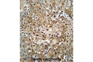 CF153 antibody (C-term) immunohistochemistry analysis in formalin fixed and paraffin embedded human cervix carcinoma followed by peroxidase conjugation of the secondary antibody and DAB staining. (CF153 (AA 233-263), (C-Term) 抗体)