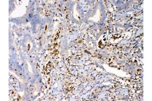 IHC testing of FFPE human rectal cancer tissue with Psoriasin antibody at 1ug/ml. (S100A7 抗体)