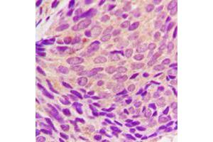 Immunohistochemical analysis of SYK (pY323) staining in human breast cancer formalin fixed paraffin embedded tissue section. (SYK 抗体  (pTyr323))