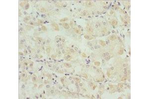 Immunohistochemistry of paraffin-embedded human gastric cancer using ABIN7171149 at dilution of 1:100 (SNAP29 抗体  (AA 1-258))