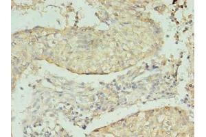 Immunohistochemistry of paraffin-embedded human lung cancer using ABIN7164305 at dilution of 1:100 (Neuregulin 2 抗体  (AA 112-405))