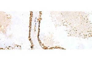 Immunohistochemistry of paraffin-embedded Human thyroid cancer tissue using LPXN Polyclonal Antibody at dilution of 1:60(x200)
