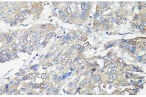 Immunohistochemistry of paraffin-embedded Human liver cancer using MUL1 Polyclonal Antibody at dilution of 1:100 (40x lens). (MUL1 抗体)