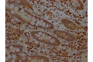 IHC image of ABIN7127612 diluted at 1:100 and staining in paraffin-embedded human colon cancer performed on a Leica BondTM system. (Recombinant MEK1 抗体)