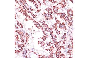 Immunohistochemistry of paraffin-embedded human thyroid cancer using RPL24 antibody (ABIN7269998) at dilution of 1:100 (40x lens). (RPL24 抗体  (AA 38-157))