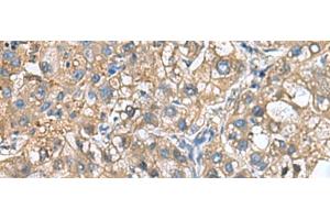 Immunohistochemistry of paraffin-embedded Human liver cancer tissue using IGLL1 Polyclonal Antibody at dilution of 1:65(x200) (IGLL1 抗体)