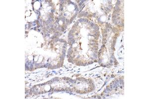 Immunohistochemistry of paraffin-embedded human colon carcinoma using MTAP Rabbit mAb (ABIN7268498) at dilution of 1:50 (40x lens). (MTAP 抗体)