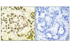 Immunohistochemical analysis of paraffin-embedded human breast carcinoma tissue using STAT5B (phospho-Ser731) antibody. (STAT5B 抗体  (pSer731))