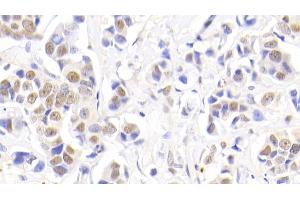 Detection of NPM1 in Human Breast cancer Tissue using Polyclonal Antibody to Nucleophosmin 1 (NPM1)