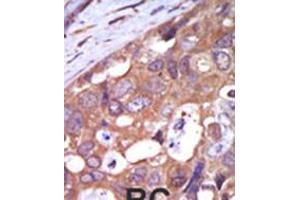 Formalin-fixed and paraffin-embedded human cancer tissue reacted with the primary antibody, which was peroxidase-conjugated to the secondary antibody, followed by AEC staining. (PKC mu 抗体  (N-Term))