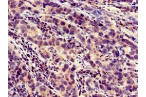 Immunohistochemistry of paraffin-embedded human pancreatic cancer using ABIN7158447 at dilution of 1:100 (LOXHD1 抗体  (AA 1101-1366))