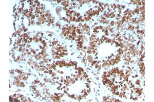 Formalin-fixed, paraffin-embedded human Colon Carcinoma stained with MSH6 Mouse Monoclonal Antibody (MSH6/3086). (MSH6 抗体  (AA 374-540))