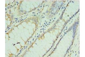 Immunohistochemistry of paraffin-embedded human colon cancer using ABIN7173555 at dilution of 1:100 (TMOD3 抗体  (AA 1-352))