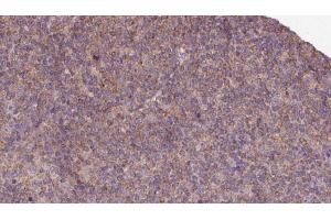 ABIN6273129 at 1/100 staining Human lymph cancer tissue by IHC-P. (KIF12 抗体  (N-Term))