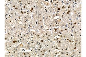 ABIN7095507 and ABIN7099564 at 1/100 staining human liver cancer by IHC-P. (CAND1 抗体)