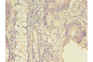 Immunohistochemistry of paraffin-embedded human colon cancer using ABIN7143981 at dilution of 1:100 (SCNN1G 抗体  (AA 90-350))