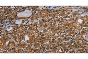 Immunohistochemistry of paraffin-embedded Human thyroid cancer tissue using UHRF2 Polyclonal Antibody at dilution 1:40