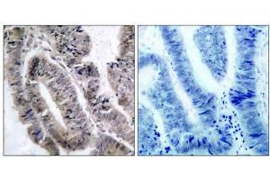 Immunohistochemical analysis of paraffin- embedded human colon carcinoma tissue, using AMPK1/AMPK2 (phospho-Ser485/Ser491) antibody (E011174). (PRKAA1/PRKAA2 抗体  (pSer485, pSer491))