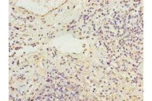 Immunohistochemistry of paraffin-embedded human cervical cancer using ABIN7168321 at dilution of 1:100 (RBMS2 抗体  (AA 1-407))