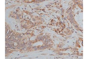 ABIN6268647 at 1/50 staining human lung cancer tissue sections by IHC-P. (TSC1 抗体  (C-Term))