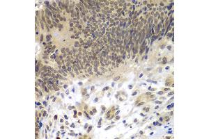 Immunohistochemistry of paraffin-embedded human colon carcinoma using CEBPG antibody (ABIN5974381) at dilution of 1/100 (40x lens). (CEBPG 抗体)