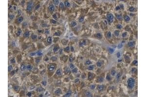 DAB staining on IHC-P; Samples: Human Liver cancer Tissue (CDKN3 抗体  (AA 1-212))