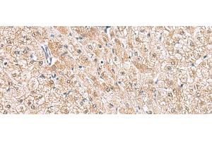 Immunohistochemistry of paraffin-embedded Human liver cancer tissue using HLA-E Polyclonal Antibody at dilution of 1:50(x200) (HLA-E 抗体)