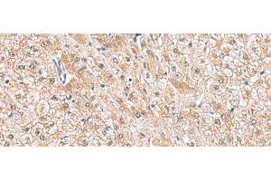 Immunohistochemistry of paraffin-embedded Human liver cancer tissue using HLA-E Polyclonal Antibody at dilution of 1:50(x200)