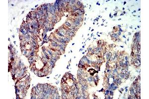 Immunohistochemical analysis of paraffin-embedded rectum cancer tissues using PRKAA2 mouse mAb with DAB staining.