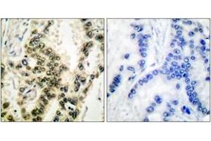 Immunohistochemistry analysis of paraffin-embedded human lung carcinoma, using SRF (Phospho-Ser99) Antibody. (SRF 抗体  (pSer103))