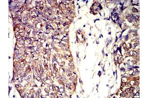 Immunohistochemical analysis of paraffin-embedded bladder cancer tissues using APC2 mouse mAb with DAB staining. (APC2 抗体  (AA 2041-2181))