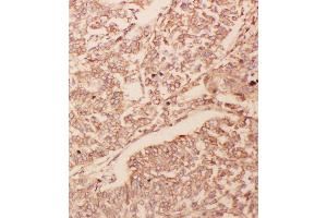Anti-GDNF antibody, IHC(P) IHC(P): Human Lung Cancer Tissue (GDNF 抗体  (Middle Region))