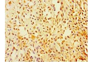 Immunohistochemistry of paraffin-embedded human breast cancer using ABIN7170920 at dilution of 1:100 (SUGCT 抗体  (AA 1-250))