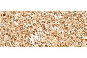 Immunohistochemistry of paraffin-embedded Human liver cancer tissue using JPT2 Polyclonal Antibody at dilution of 1:65(x200) (JPT2 抗体)
