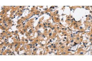 Immunohistochemistry of paraffin-embedded Human thyroid cancer tissue using CLEC2D Polyclonal Antibody at dilution 1:70 (CLEC2D 抗体)