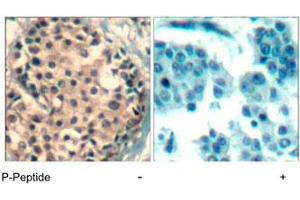 Immunohistochemical analysis of paraffin-embedded human breast carcinoma tissue using HDAC4/HDAC5/HDAC9 (phospho S246/259/220) polyclonal antibody . (HDAC4 抗体  (pSer220, pSer246, pSer259))