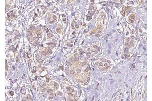 ABIN6274740 at 1/100 staining Human breast cancer tissue by IHC-P. (MRPL40 抗体  (C-Term))