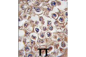 Formalin-fixed and paraffin-embedded human testis tissue reacted with INSRR polyclonal antibody  , which was peroxidase-conjugated to the secondary antibody, followed by DAB staining. (INSRR 抗体  (N-Term))