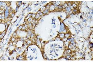 Immunohistochemistry of paraffin-embedded Human colon carcinoma using MTIF2 Polyclonal Antibody at dilution of 1:100 (40x lens). (MTIF2 抗体)