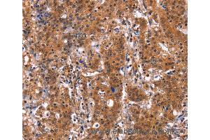 Immunohistochemistry of Human gastric cancer using GUK1 Polyclonal Antibody at dilution of 1:50 (GUK1 抗体)