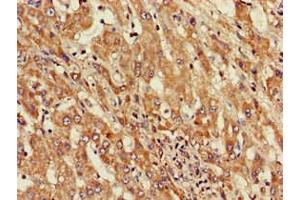 Immunohistochemistry of paraffin-embedded human liver cancer using ABIN7143803 at dilution of 1:100 (ST8SIA5 抗体  (AA 101-376))